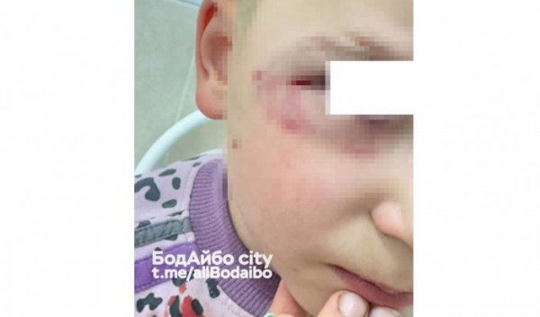 В Бодайбо собака покусала ребенка за лицо В Бодайбо собака покусала ребенка за лицо